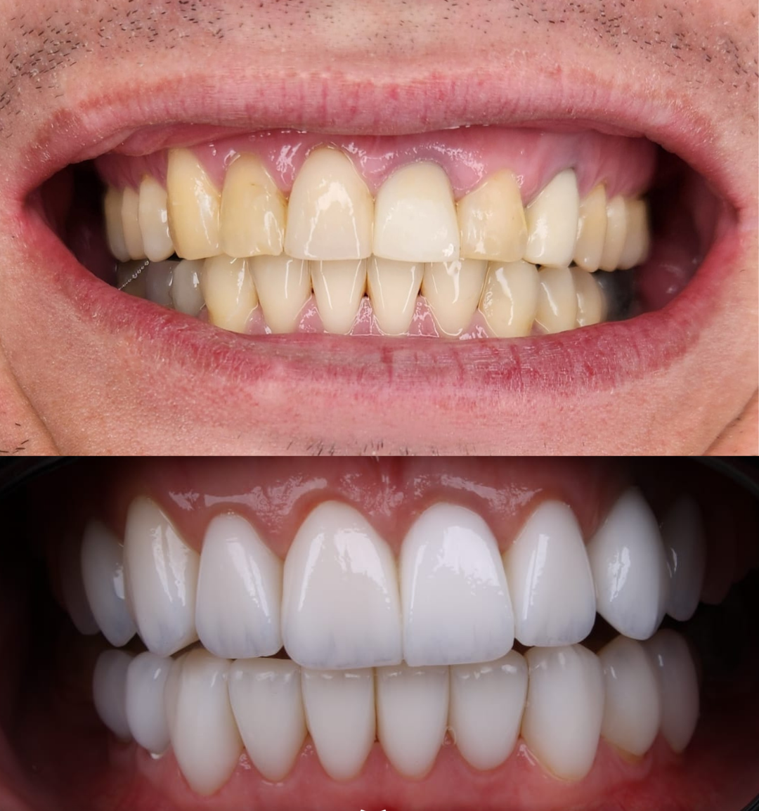 Implantes - Facetas e lentes dental - proteses - Clareamento (5)